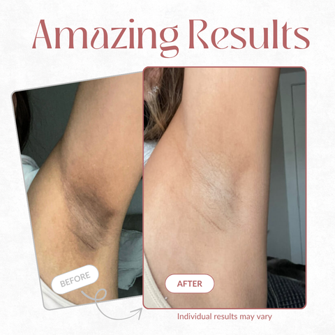 Body Peel Spray - Kojic + Turmeric